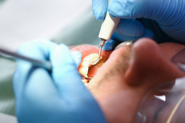 Best Broken or Chipped Tooth Repair in Blue Earth, MN